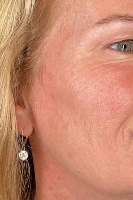 Before treatment result