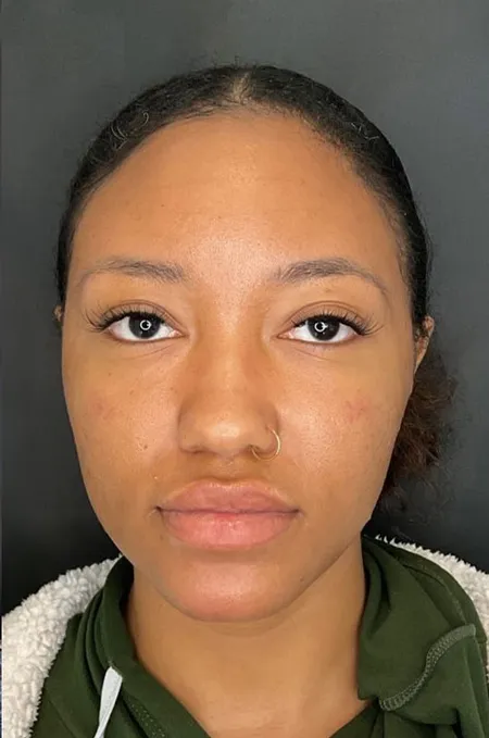 Before treatment result