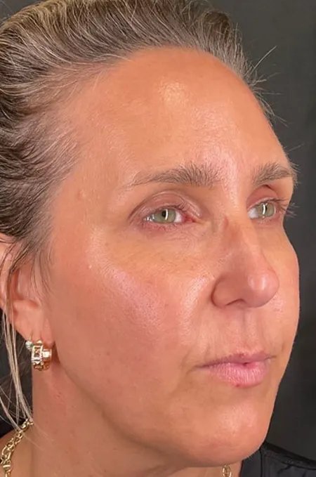 Before treatment result