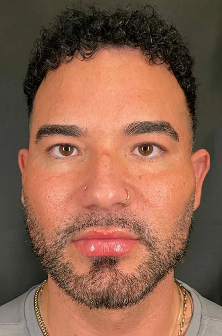 After treatment result