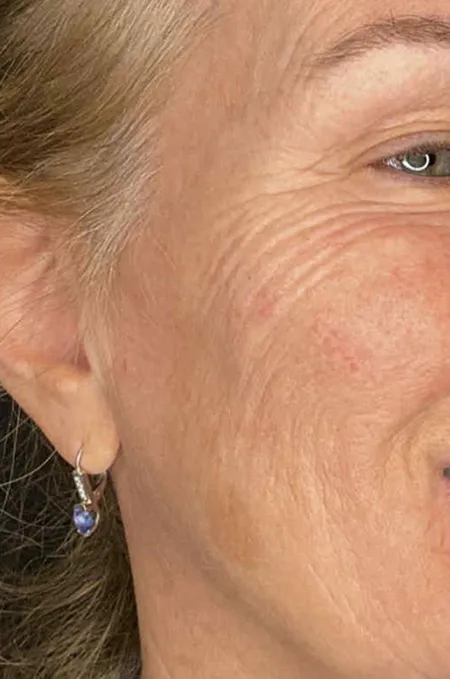 After treatment result