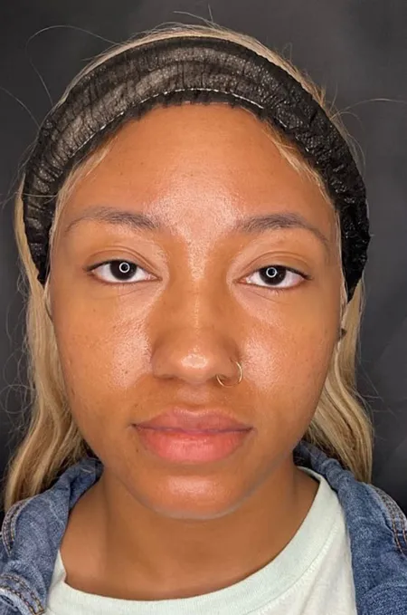 After treatment result