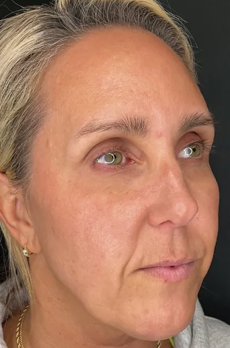 After treatment result