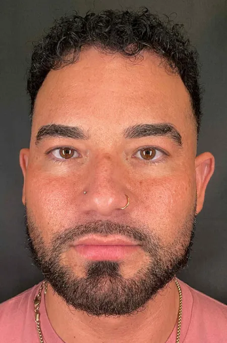 Before treatment result